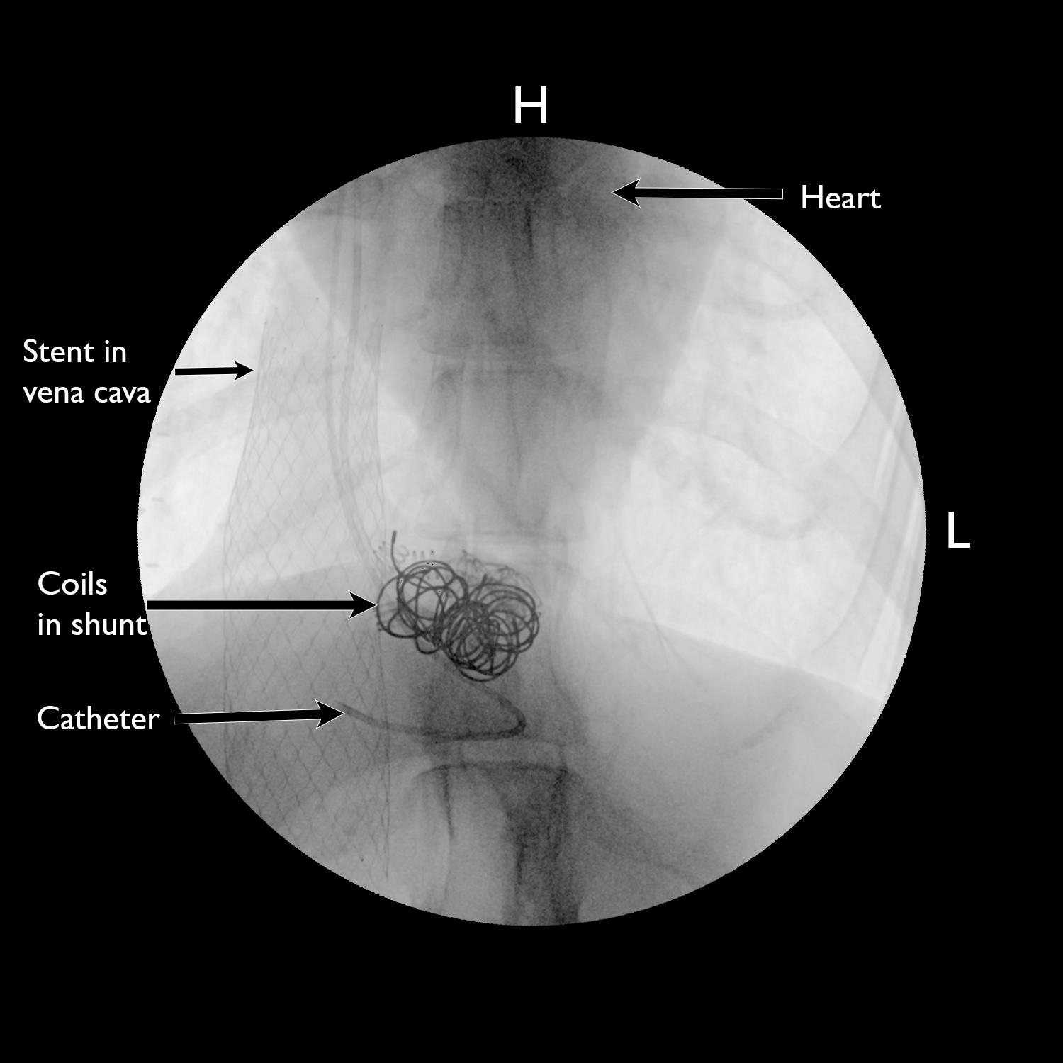 Fluoroscopic X-ray showing coils in a shunt, catheter and vena cava stent